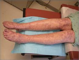 Hội chứng kháng thể kháng phospholipid - Hình ảnh minh họa